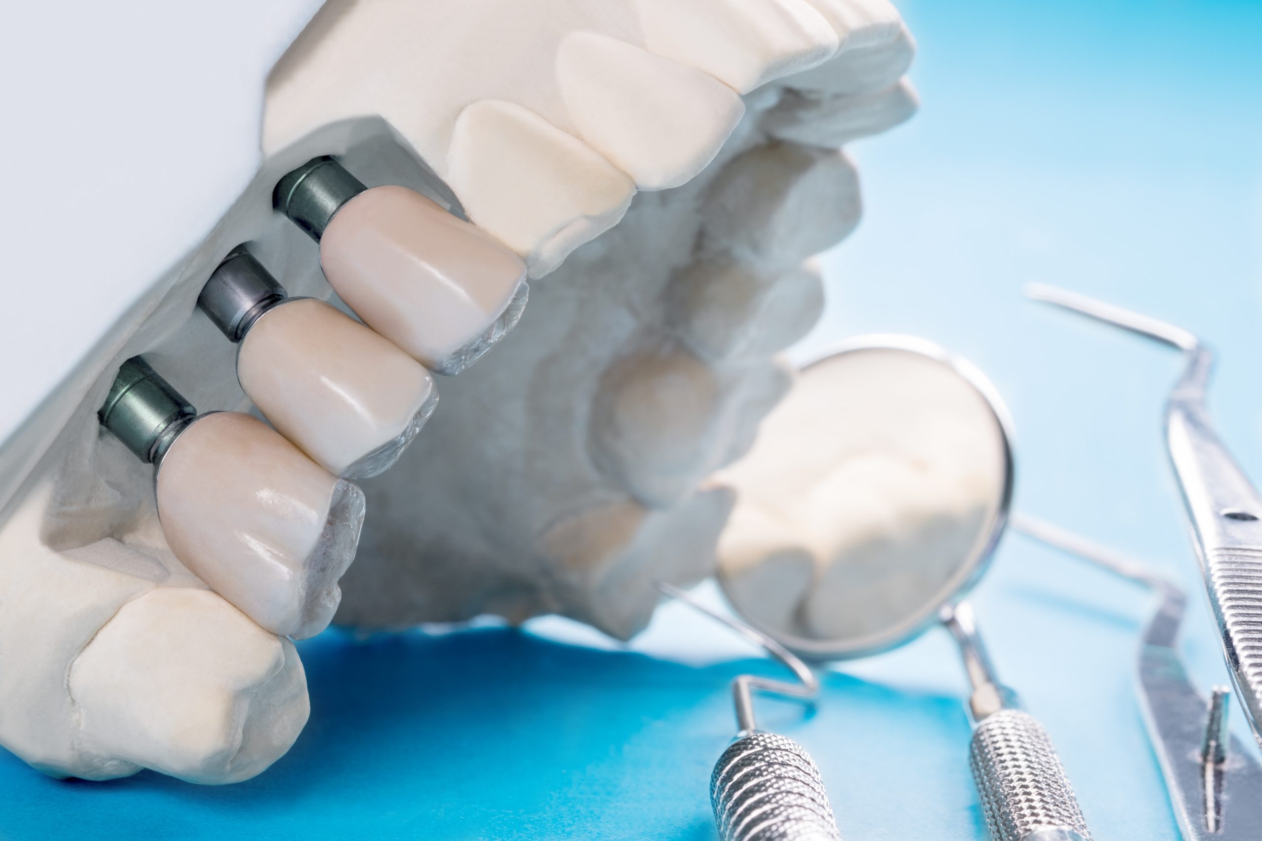 Saiba tudo sobre implante dentário